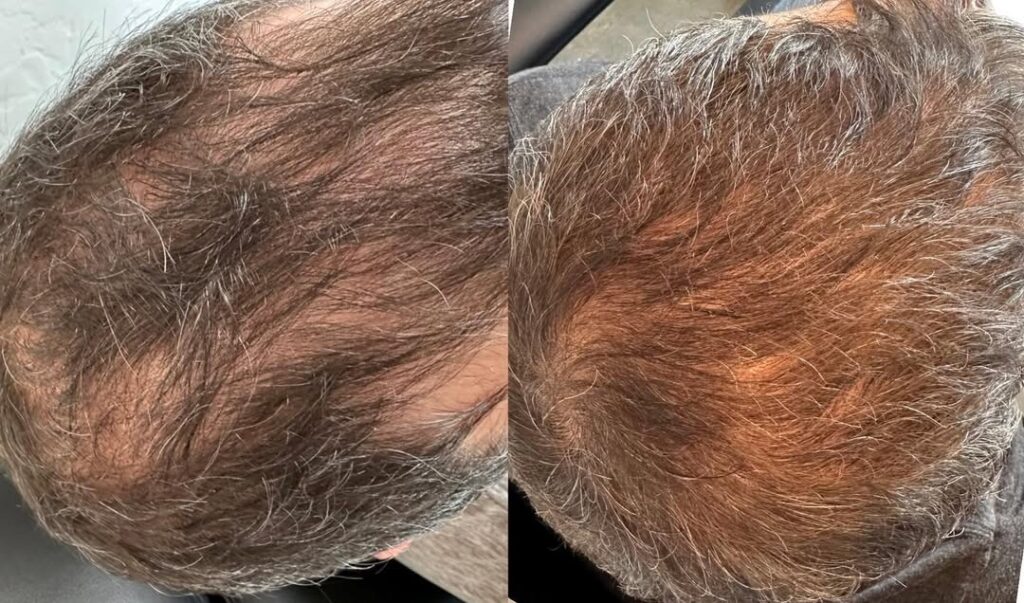 Patient before and after from PRP hair treatment