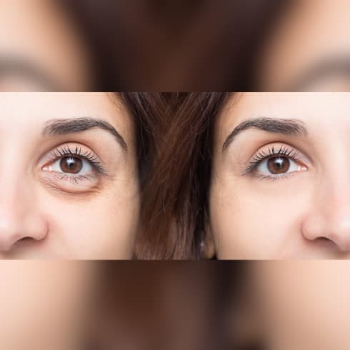 Before and after comparison showing under-eye area improvement with reduced dark circles and fine lines following PRF microneedling treatment